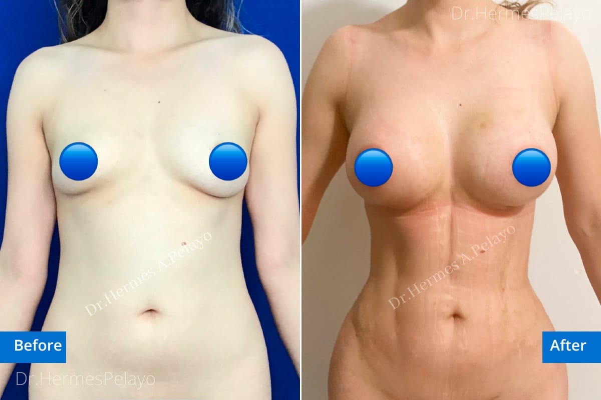 Liposculpture with Breast Augmentation