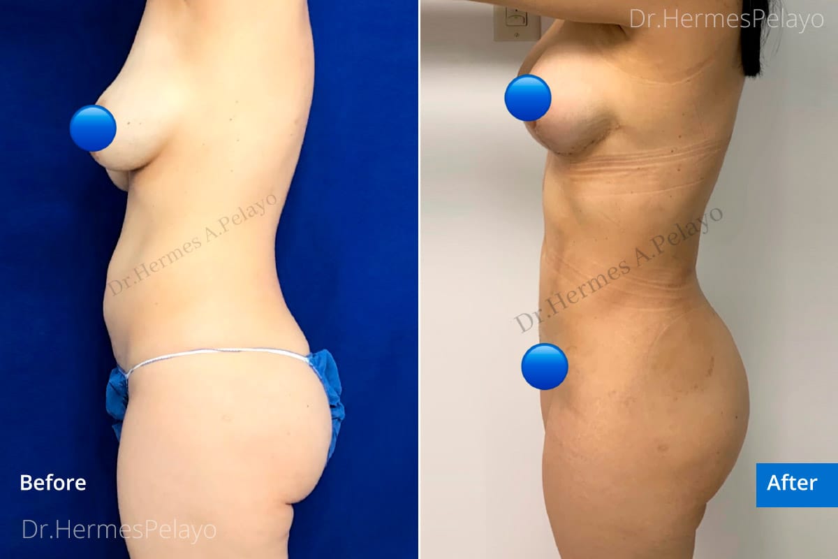 Liposuction with Fat Transfer