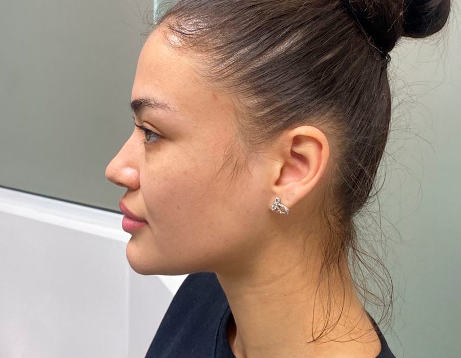 Patient transformation before and after cosmetic surgery — Ciplastic