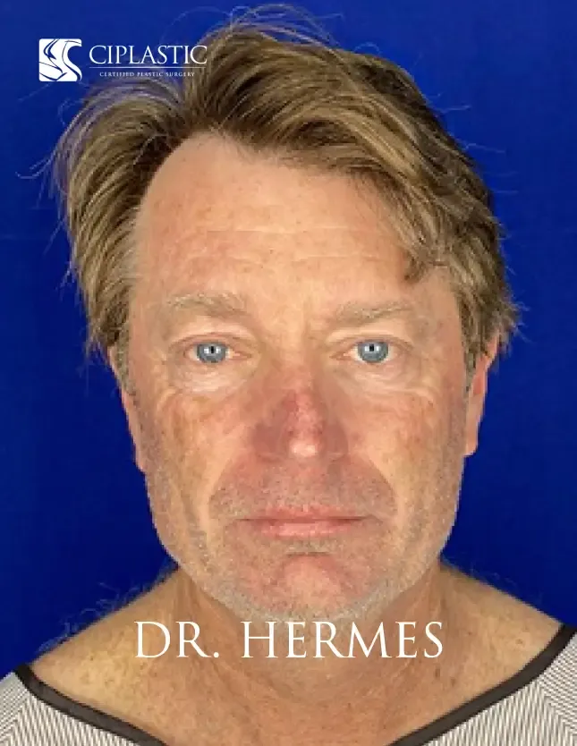 Ciplastic plastic surgery results