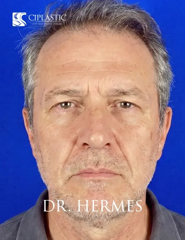 Ciplastic plastic surgery results