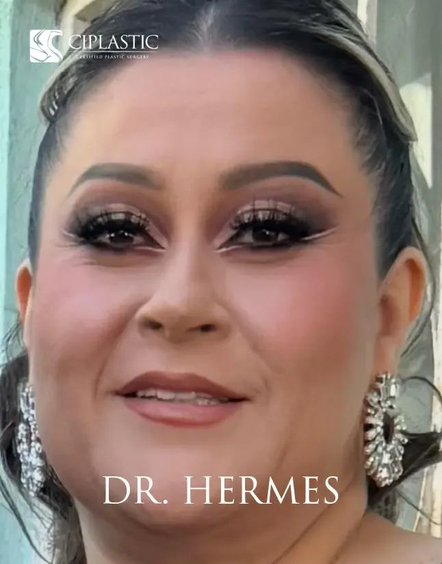 Ciplastic plastic surgery results