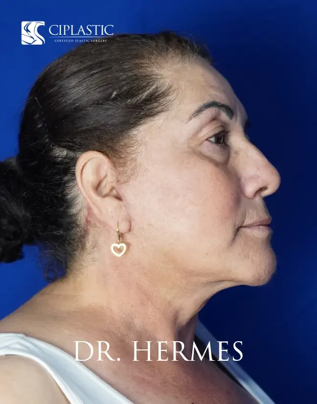Ciplastic plastic surgery results