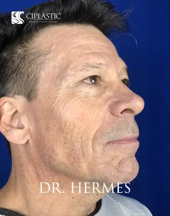 Ciplastic plastic surgery results