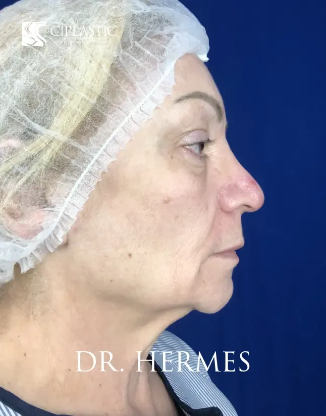 Ciplastic plastic surgery results