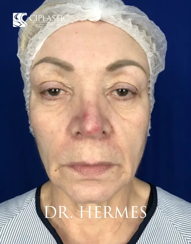 Ciplastic plastic surgery results