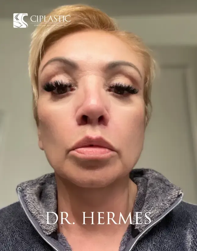 Ciplastic plastic surgery results