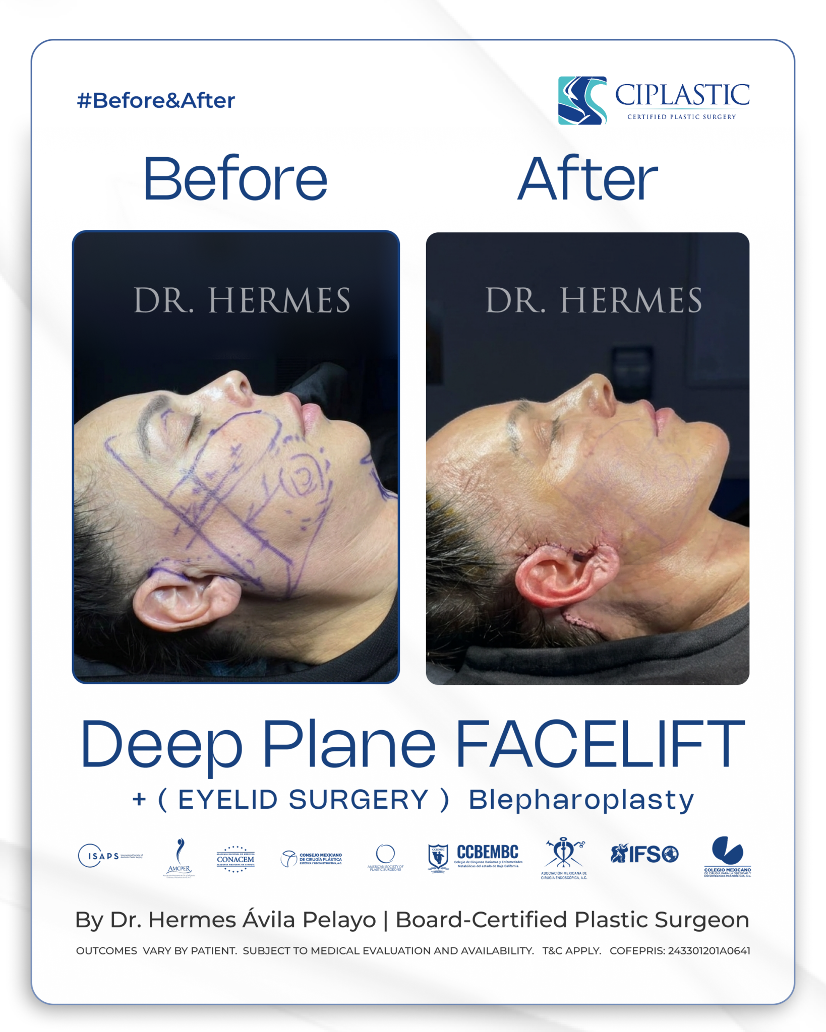 Ciplastic plastic surgery results