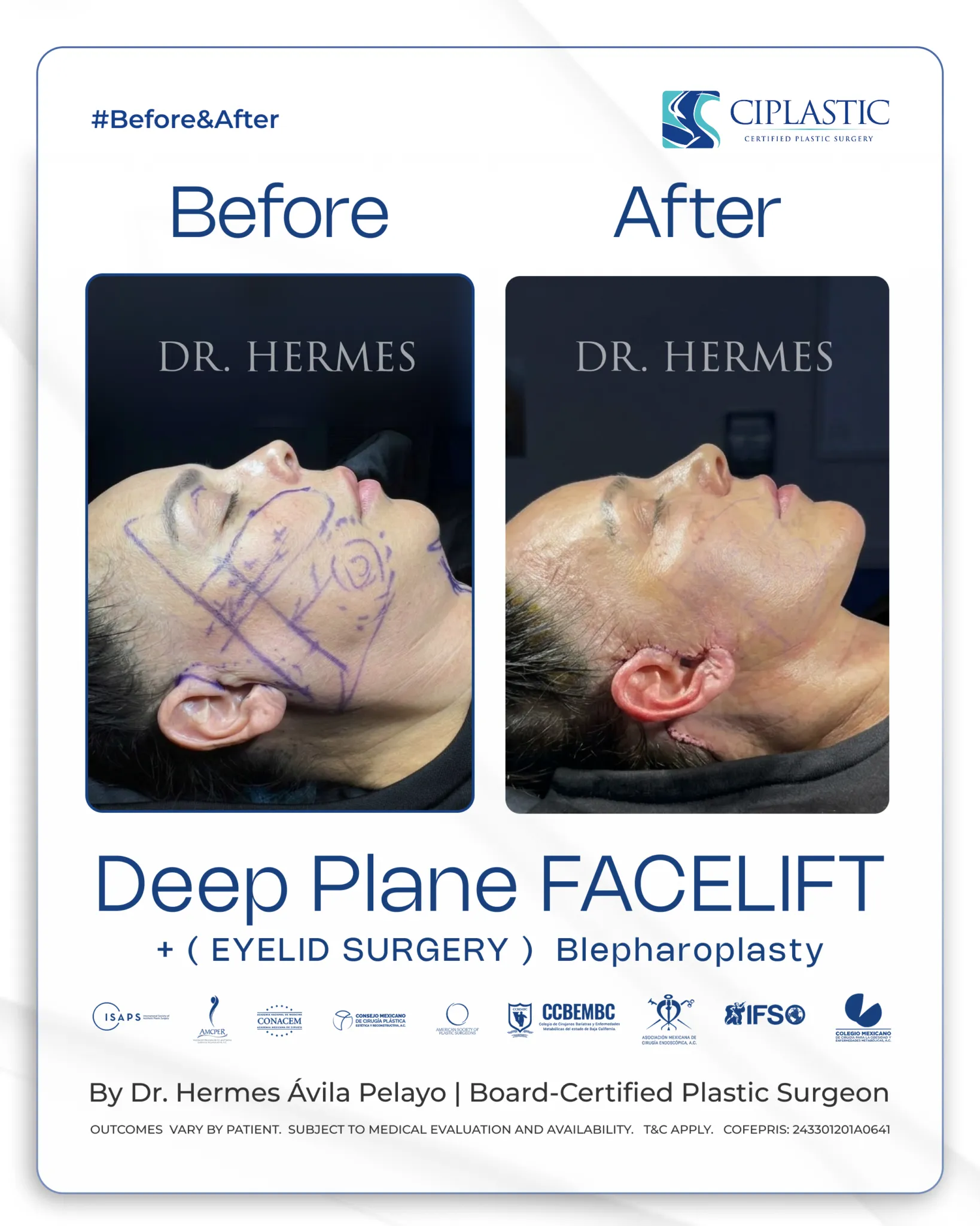 Ciplastic plastic surgery results