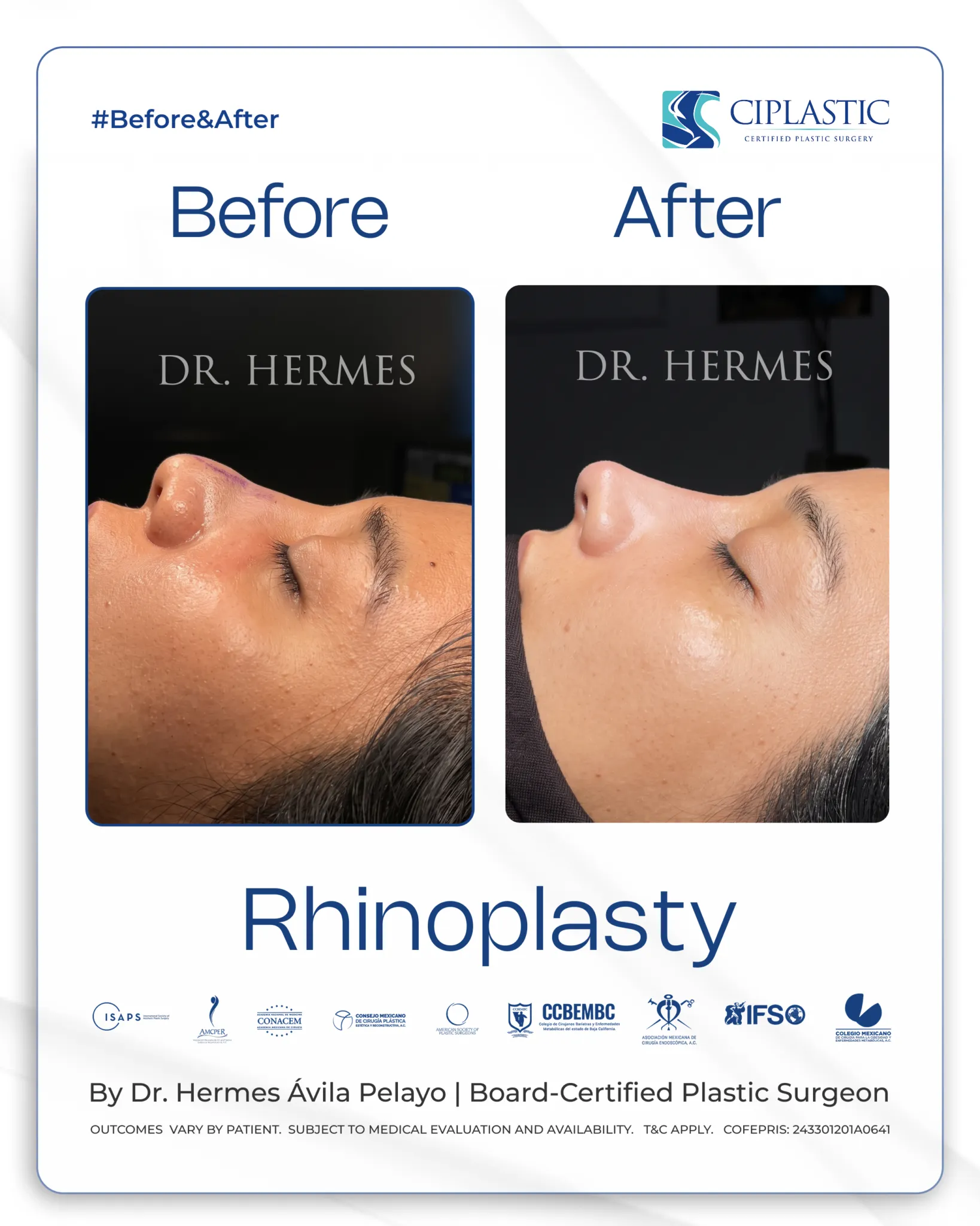 Ciplastic plastic surgery results