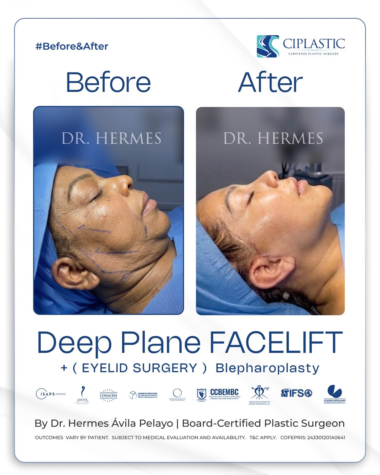 Ciplastic plastic surgery results